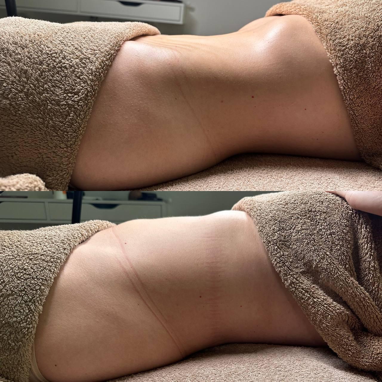Endospheres Bauch vorher und nachher