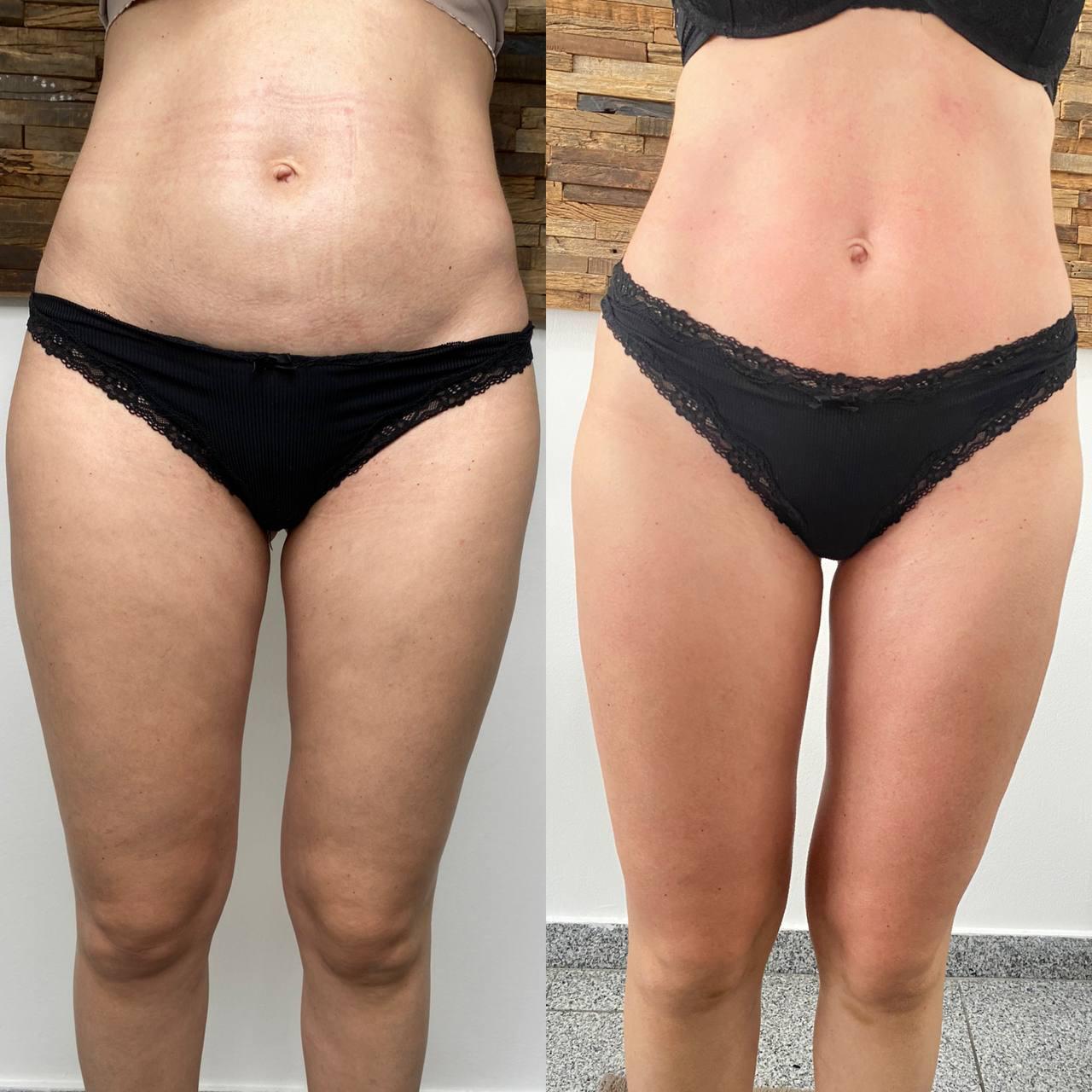 Endospheres Bauch und Oberschenkel vorher und nachher