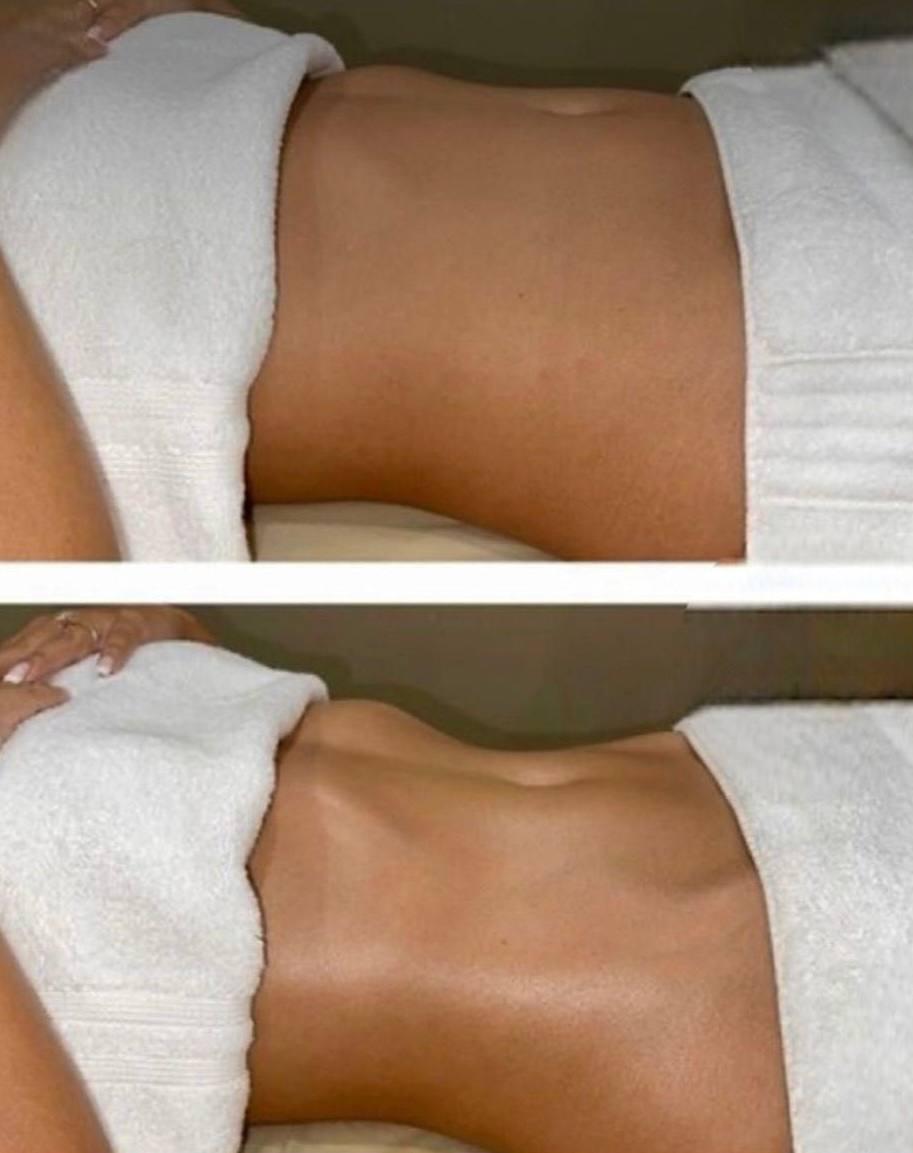 Endospheres Bauch-Sculpting vorher und nachher