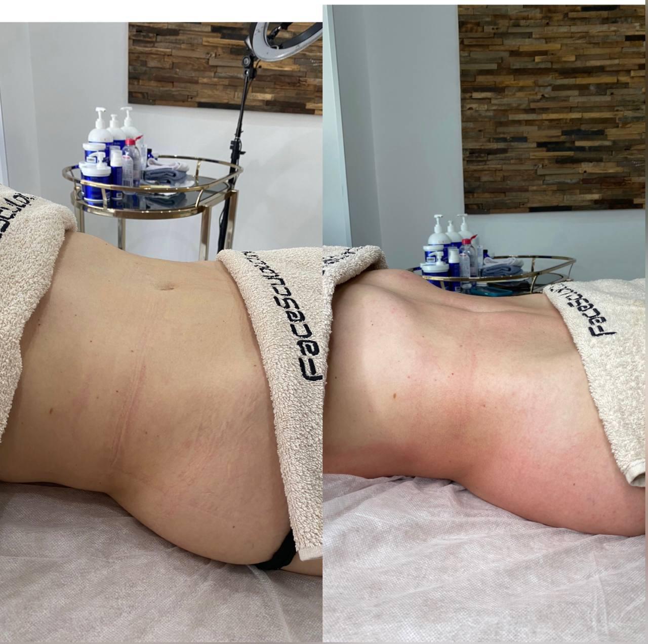 Body Treatments