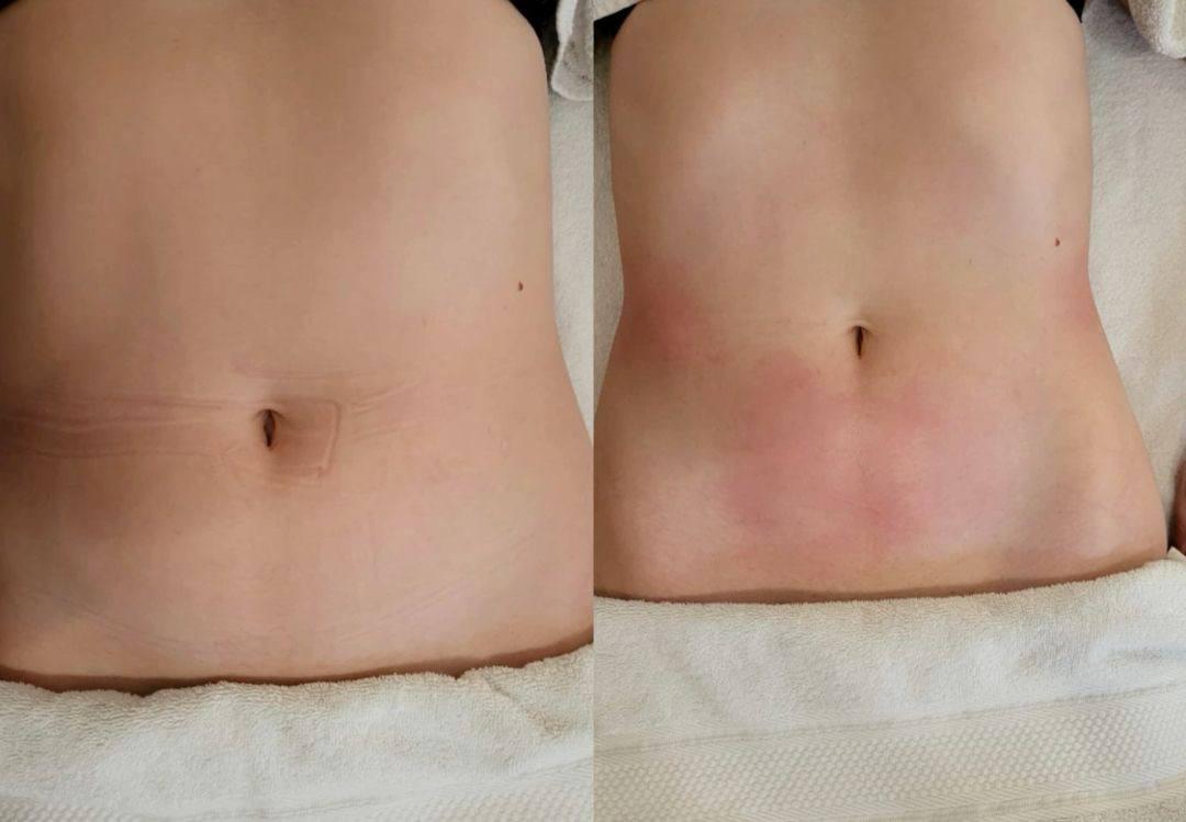 Endospheres Bauch straffen vorher und nachher