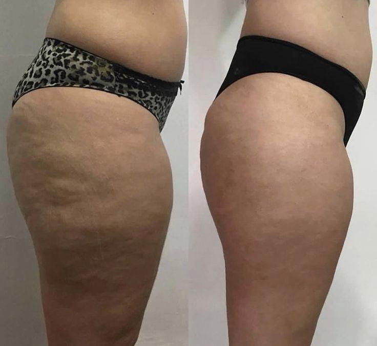 Endospheres Oberschenkel Cellulite vorher und nachher