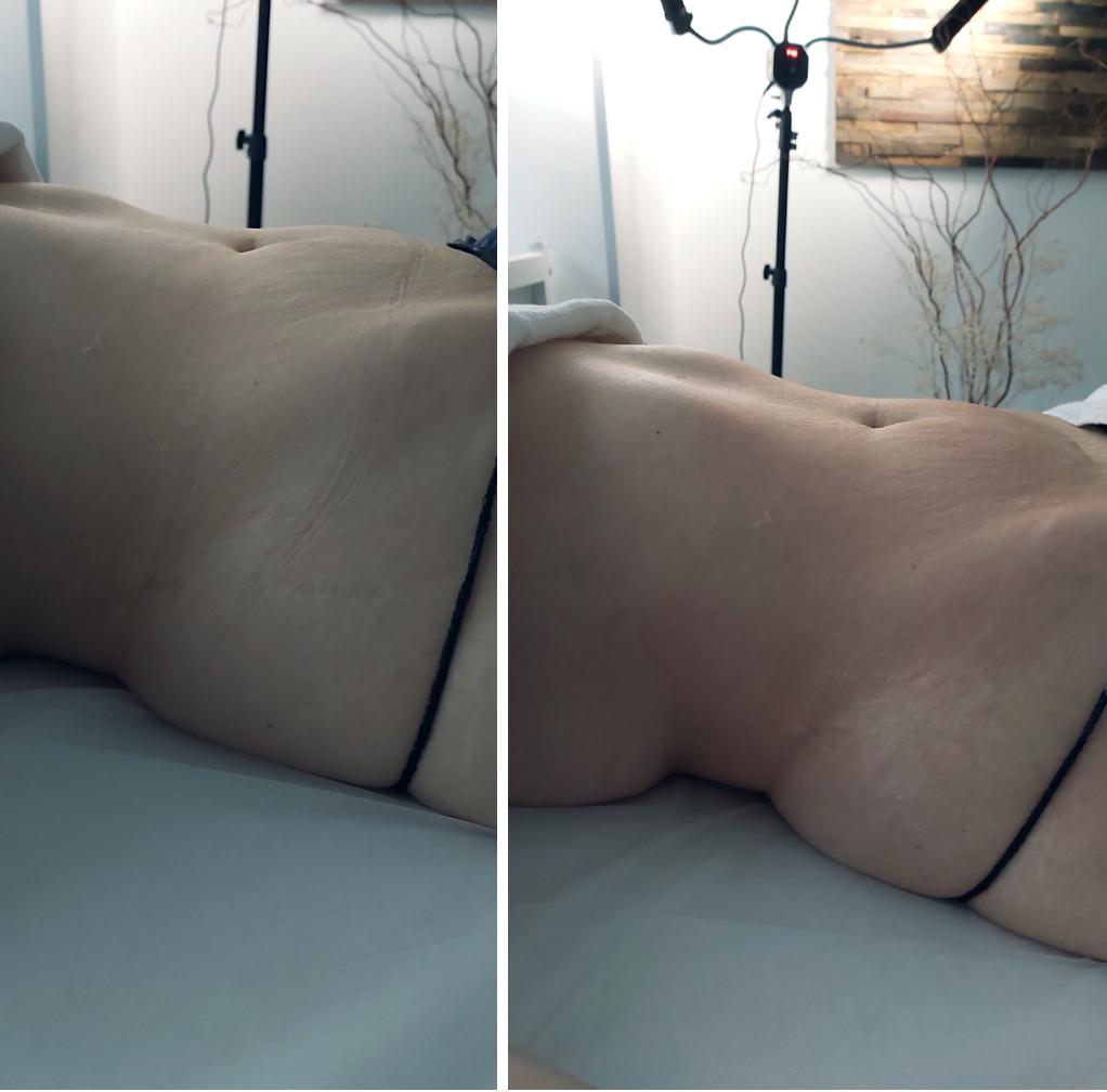 Endospheres Bauch glätten vorher und nachher