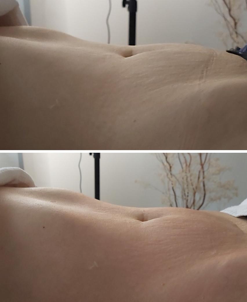 Endospheres Bauch tonen vorher und nachher
